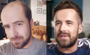 Men's hair replacement systems at Blonde Envy hair salons in Milton Keynes